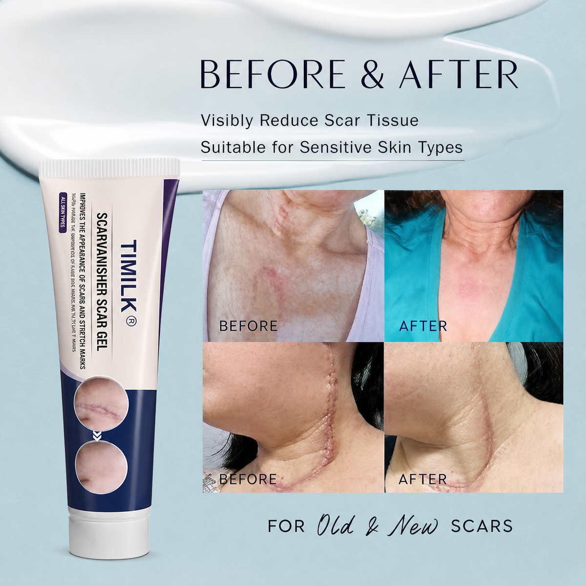 TIMILK Scar Vanisher Gel – Advanced Silicone Formula for Scars, Stretch Marks & Smooth Skin (Before & After Results)